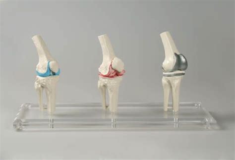 Knee-Implant-Model | Physiosupplies.eu