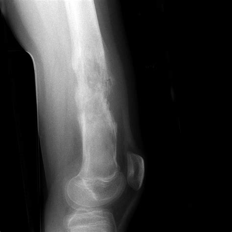 Distal femoral osteosarcoma complicated by pathological fracture | Image | Radiopaedia.org