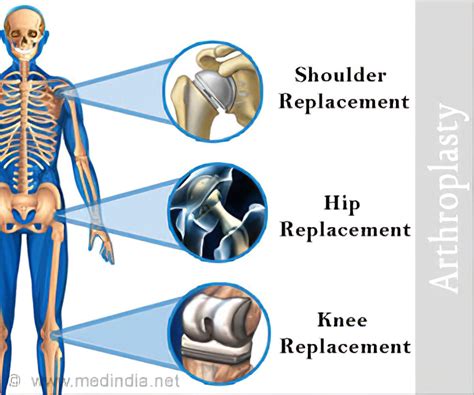 Arthroplasty - Surgical Procedure, Risks, Complications, Recovery ...