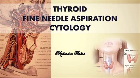 THYROID FNAC - YouTube