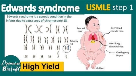 Understanding Edwards' Syndrome: Causes, Symptoms, and Treatment - Ask ...