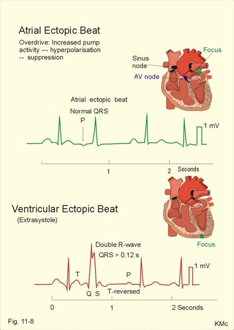 Image result for ventricular ectopic beats | Physiology, Medical student study, Nursing student ...