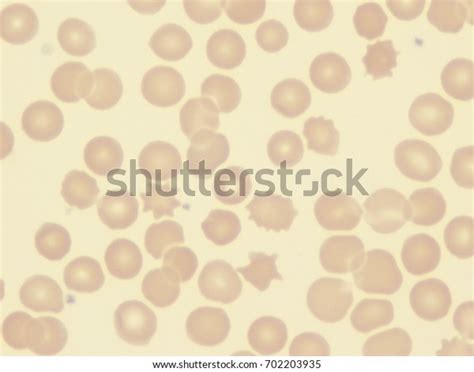 46 Acanthocytosis Images, Stock Photos & Vectors | Shutterstock