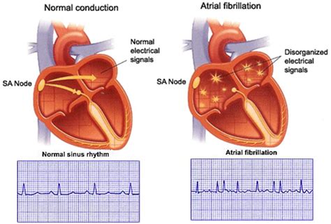 CatheterForceSensing