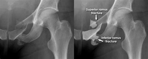 Trauma X-ray - Axial skeleton gallery 2 - Pelvis - Pubic ramus fractures