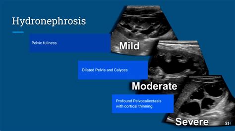 Grading System Hydronephrosis In Adults