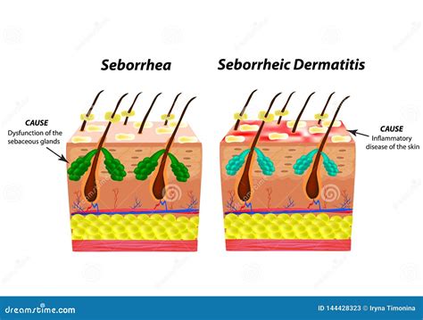 Causes Seborrhea Skin and Hair. Dandruff Seborrheic Dermatitis. Eczema Stock Vector ...