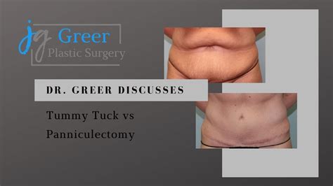 Tummy Tuck vs Panniculectomy | Greer Plastic Surgery | Cleveland, OH - YouTube