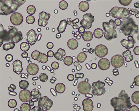 Calcium carbonate crystals | eClinpath