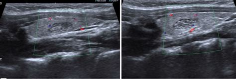 Intrathyroidal ectopic thymus: Ultrasonographic features and differential diagnosis