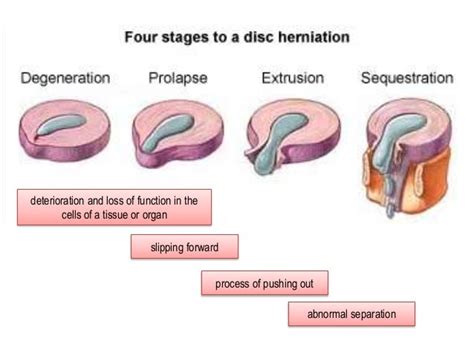 Herniated Nucleus Pulposus