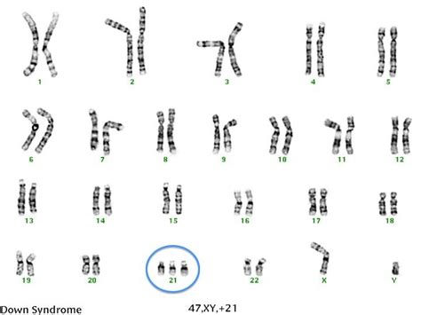 Down Syndrome Karyotype : Trisomy 21 - Embryology - Down syndrome may be suspected if a newborn ...