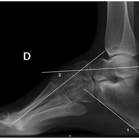 Severe cavovarus deformity treated by Tarsal osteotomy. | Download Scientific Diagram