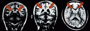 Bipolar Brain Imaging Provides a Major Breakthrough | Bipolar Lives