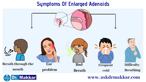 Adenoid || Adenoid facies || Nasal Polyp || Causes || Homeopathic ...