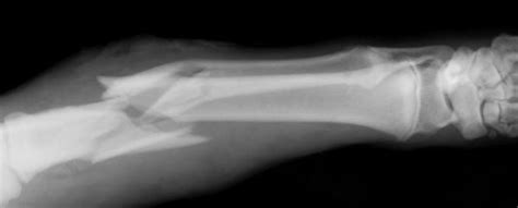 Osteogenesis imperfecta (Brittle bone disease) | myVMC