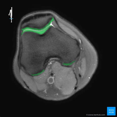 Descolorar Los Alpes Diplomacia resonancia magnetica de rodilla simple ...