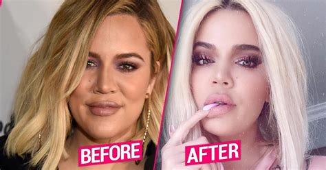 Khloe Kardashian’s Plastic Surgery Makeover After Split