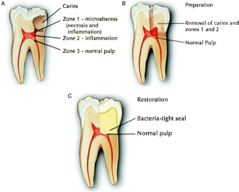 Root Canal Alternative holistic biologic iaomt dentist charlotte nc