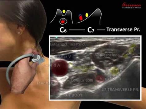 ULTRASOUND GUIDED STELLATE GANGLION BLOCK - YouTube