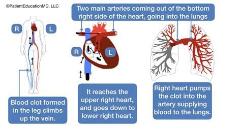 Can Coughing Be A Symptom Of Lung Cancer