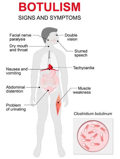 Botulism outbreak raises public health concerns in California | Food Safety News