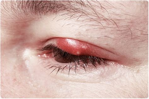 Blepharitis Types and Causes - Bhaskar Health: trustworthy health news and medical information