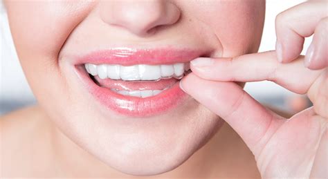 SureSmile vs. Smile Direct Aligners: Which is Better? | Build-A-Smile