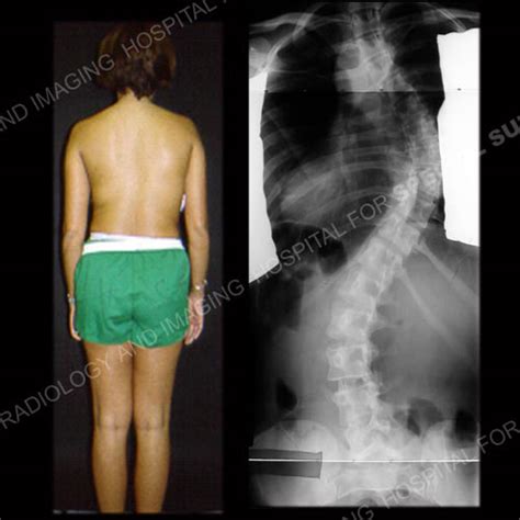 Scoliosis in Adults: What to Know About Symptoms & Treatment