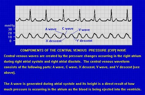 CVP waveform. Normal range for CVP 3-12 cm water pressure. Used to monitor fluid replacement in ...