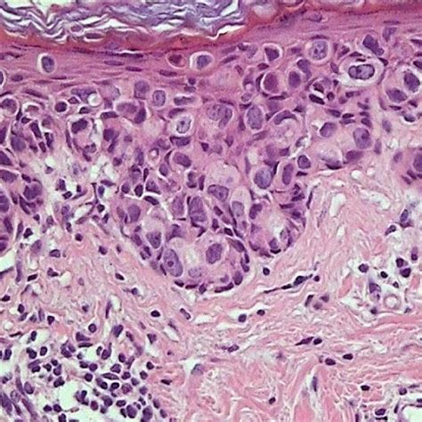 Pagets Disease Of Breast Histology Diagram : Extramammary Paget Disease ...