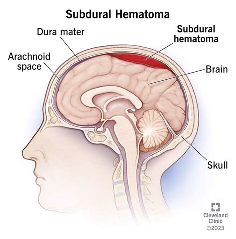 Subdural Hematoma: What It Is, Causes, Symptoms & Treatment