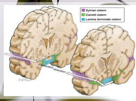 Sylvian Fissure Anatomy