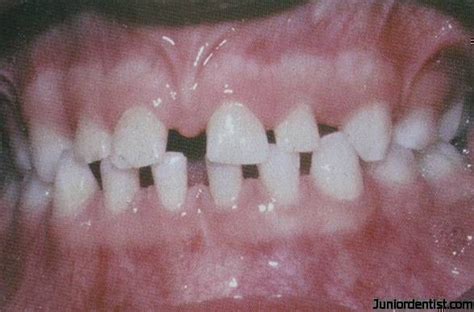 Microdontia - Developmental Disturbances in Size of teeth