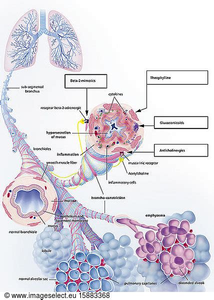 Chronic obstructive pulmonary disease COPD and its treatments. In the upper left Chronic ...