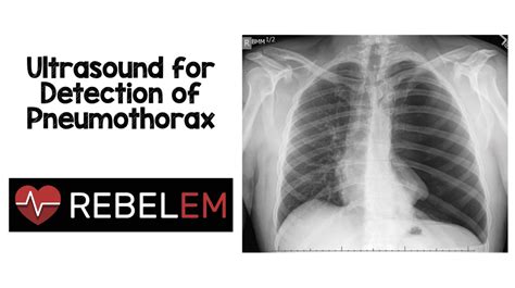 Ultrasound for Detection of Pneumothorax – MED-TAC International Corp.