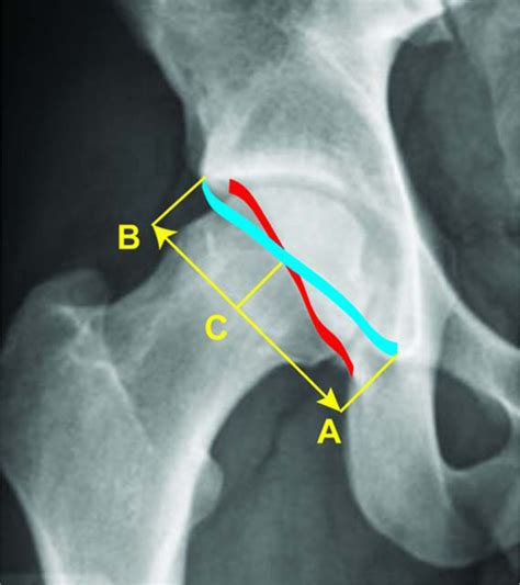 Radiographic Diagnosis of Pincer-Type Femoroacetabular Impingement: A Systematic Review ...