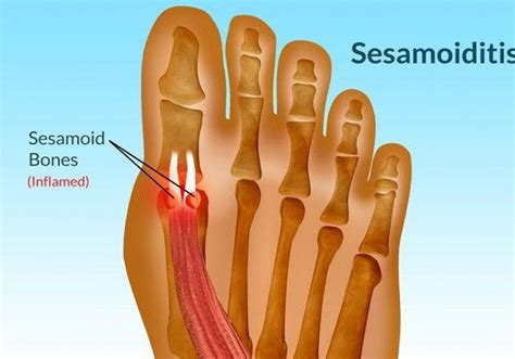 Big toe joint injuries | Features Local | trinidadexpress.com