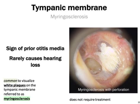 Myringosclerosis