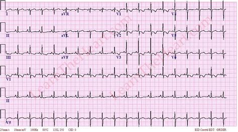 Right Ventricular Hypertrophy with strain (RVH) ECG Example 1 ...