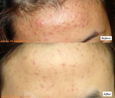 PSCLY: Acne and Proactiv Solution