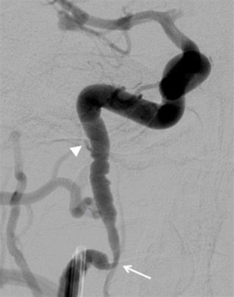 Cerebral catheter angiography and its complications | Practical Neurology