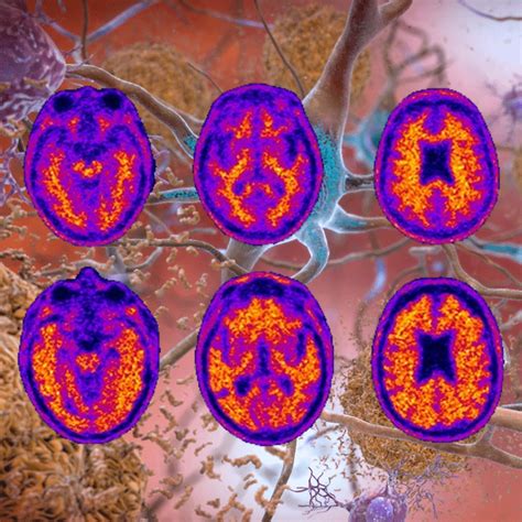 Alzheimer's disease : researchers found that by removing brain immune cells beta-amyloid plaques ...