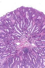 Inflammatory pseudopolyp - Libre Pathology