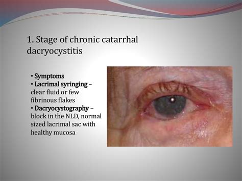 Chronic dacryocystitis