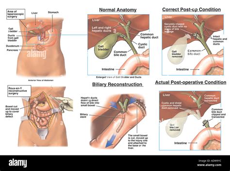 Laparoscopic Cholecystectomy Gallbladder Removal Procedure with ...