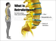 Retrolistesis Grado 1