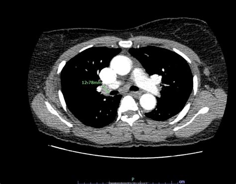 Hilar Lymphadenopathy Ct Scan