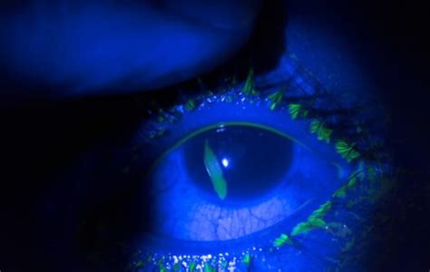 Corneal Abrasion- Symptoms, Causes, and Treatment