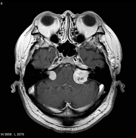 Vestibular Health — Neurofibromatosis type II (NF2)